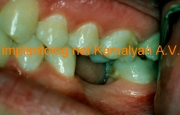 Имплантация зубов качественно в Марьино у специалиста